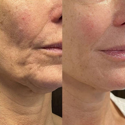 Bellarè Menopause Sculptor™