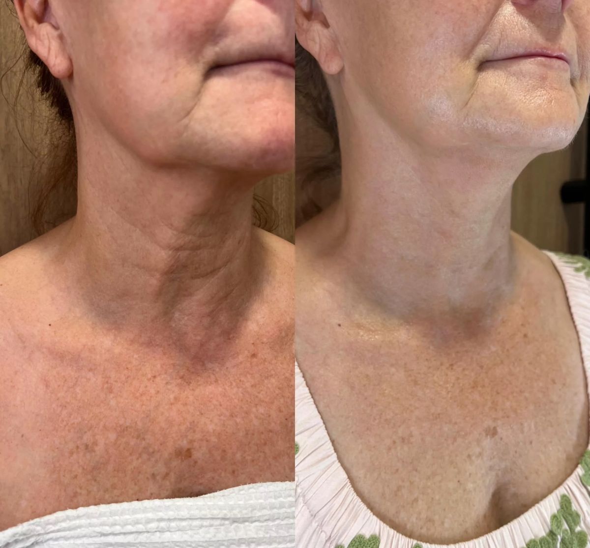 Bellarè Menopause Sculptor™