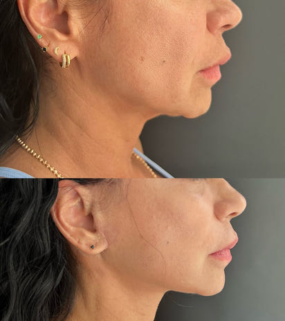 Bellarè Menopause Sculptor™