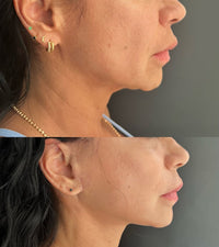 Bellarè Menopause Sculptor™